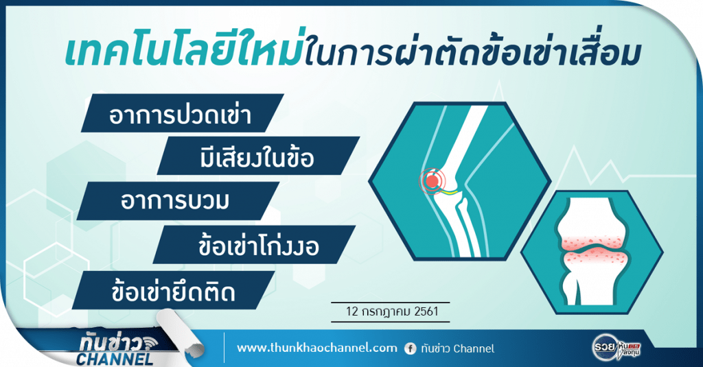 ทันข่าวสุขภาพ | เทคโนโลยีใหม่ในการผ่าตัดข้อเข้าเสื่อม