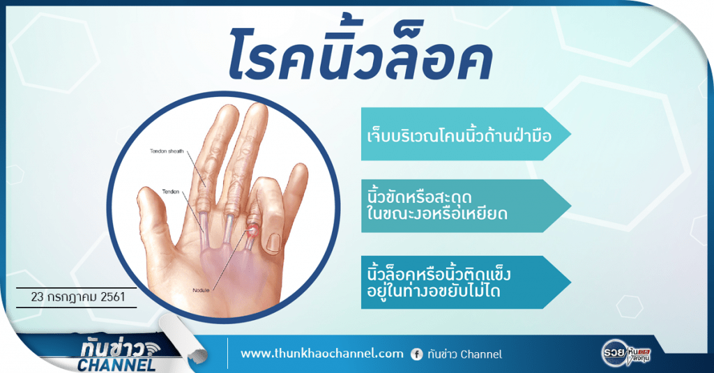 ทันข่าวสุขภาพ | โรคนิ้วล็อค