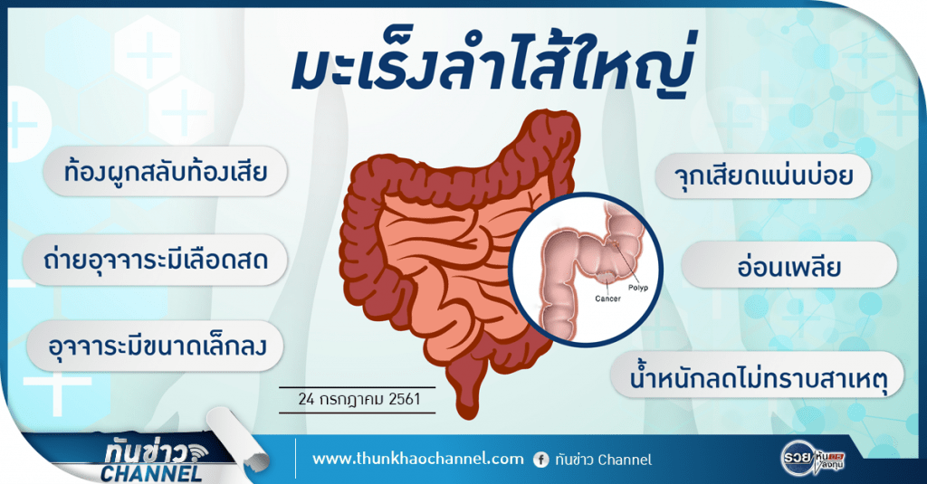 ทันข่าวสุขภาพ | มะเร็งลำไส้ใหญ่