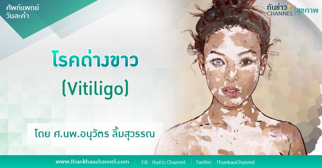 โรคด่างขาว(Vitiligo)