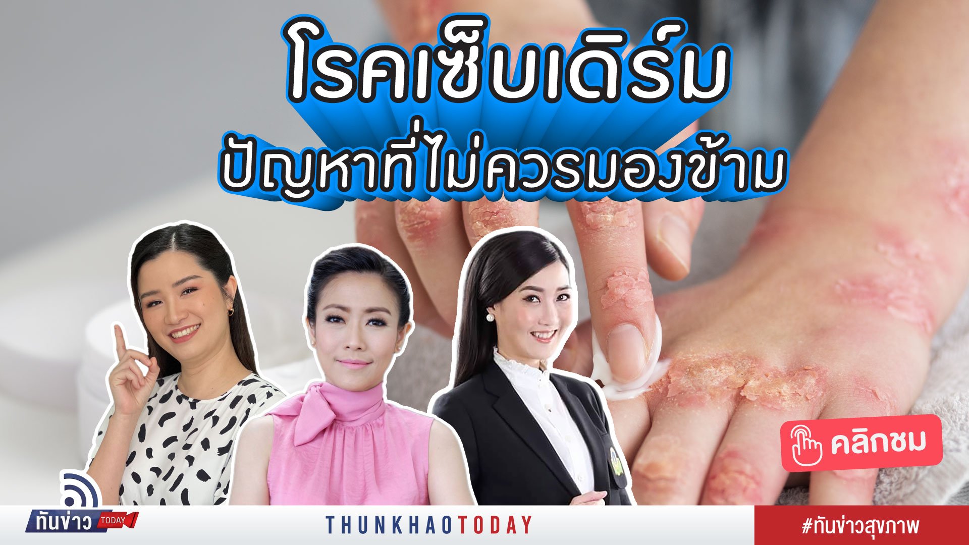 โรคเซ็บเดิร์ม โรคผิวหนังที่ควรทำความรู้จัก