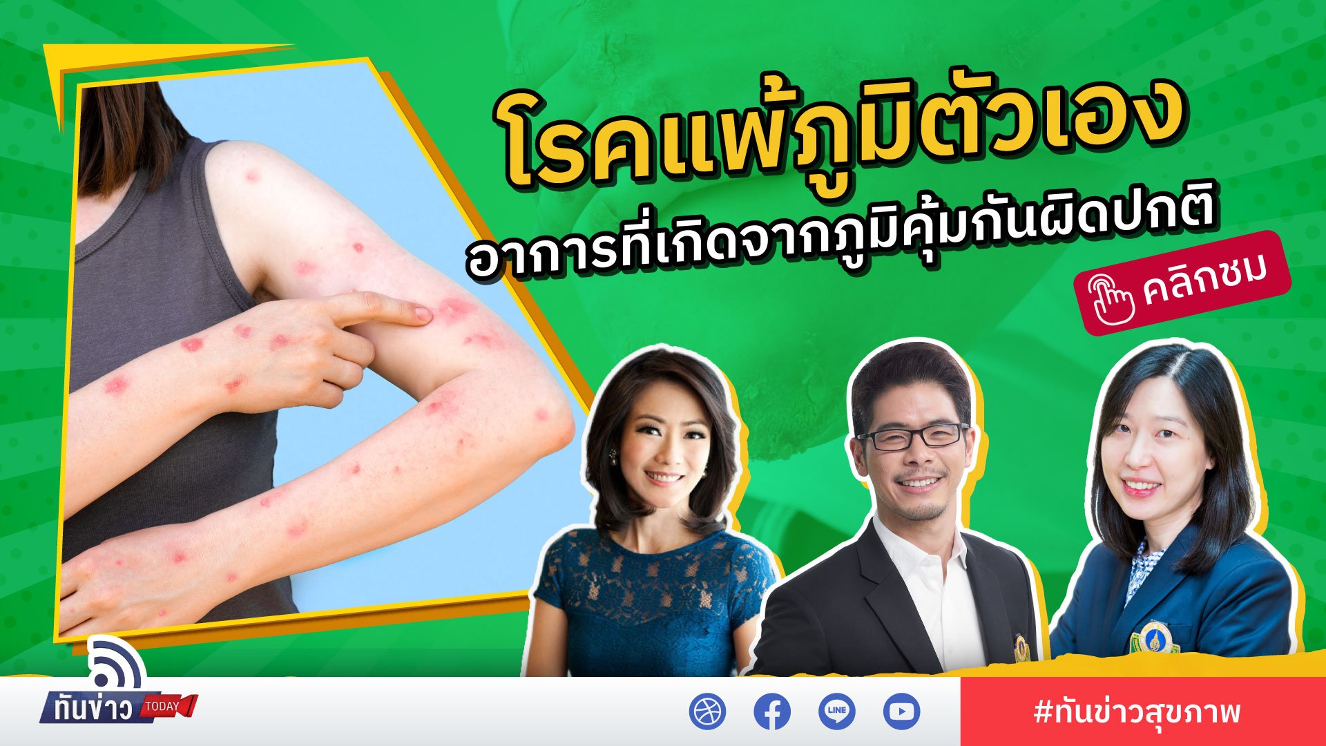 โรคแพ้ภูมิตัวเอง อาการทางระบบประสาทเกิดจากภูมิคุ้มกันผิดปกติ